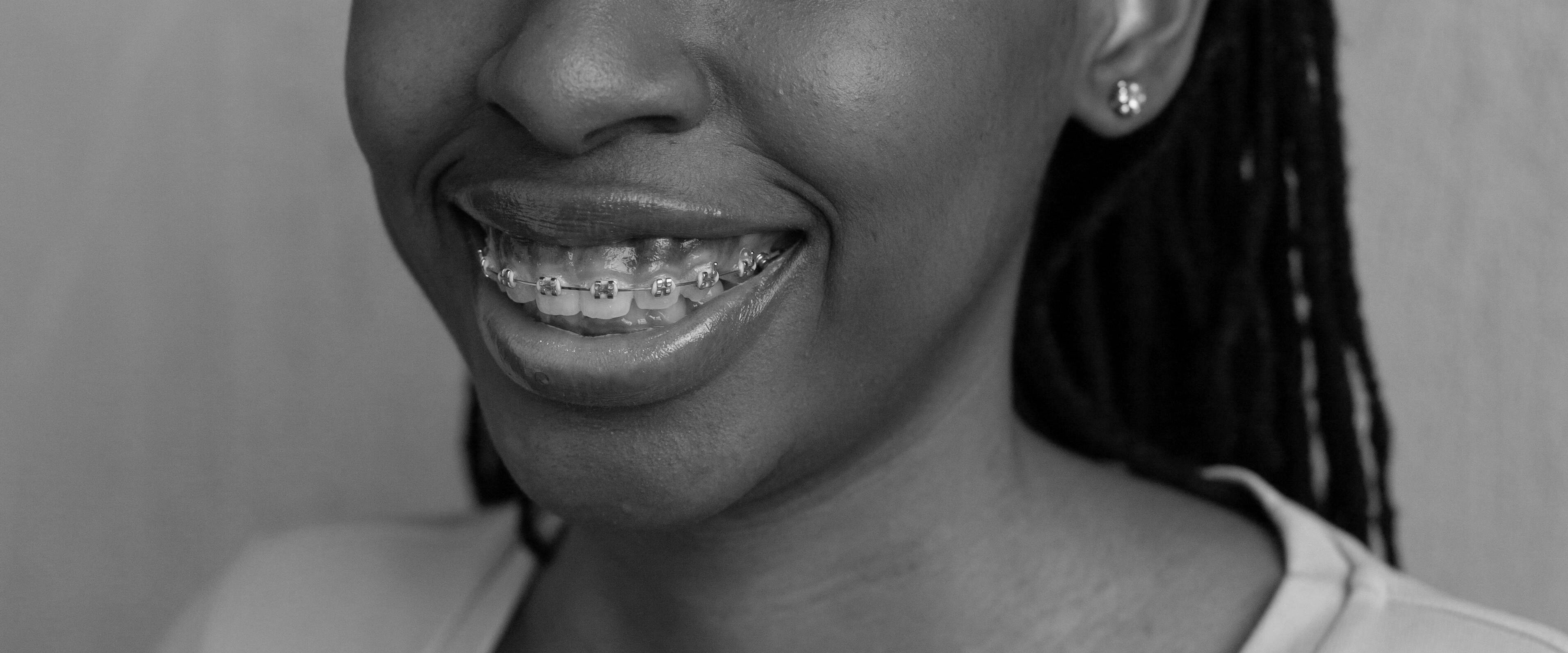 Ortodontia na Castro Odontologia Especializada Londrina